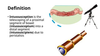 Comprehensive Pediatric Intussusception: Diagnosis, Management, and ...