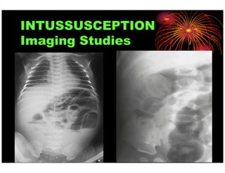 Intussusception Micrograph Pediatric Intussusception - An Overview | PDF