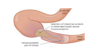Nursing management of children with intussusception | PPTX