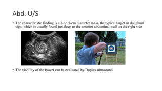 Abd. U/S
• The characteristic finding is a 3- to 5-cm diameter mass, the typical target or doughnut
sign, which is usually found just deep to the anterior abdominal wall on the right side
• The viability of the bowel can be evaluated by Duplex ultrasound
 