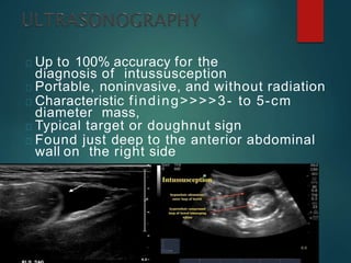 Up to 100% accuracy for the
diagnosis of intussusception
Portable, noninvasive, and without radiation
Characteristic finding>>>>3- to 5-cm
diameter mass,
Typical target or doughnut sign
Found just deep to the anterior abdominal
wall on the right side
 