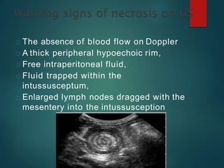 The absence of blood flow on Doppler
A thick peripheral hypoechoic rim,
Free intraperitoneal fluid,
Fluid trapped within the
intussusceptum,
Enlarged lymph nodes dragged with the
mesentery into the intussusception
 