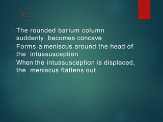 The rounded barium column
suddenly becomes concave
Forms a meniscus around the head of
the intussusception
When the intussusception is displaced,
the meniscus flattens out
 