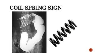 Spring Sign Intersusception INTUSSUSCEPTION ,MANAGEMENT AND COMPLICATIONS | PPTX