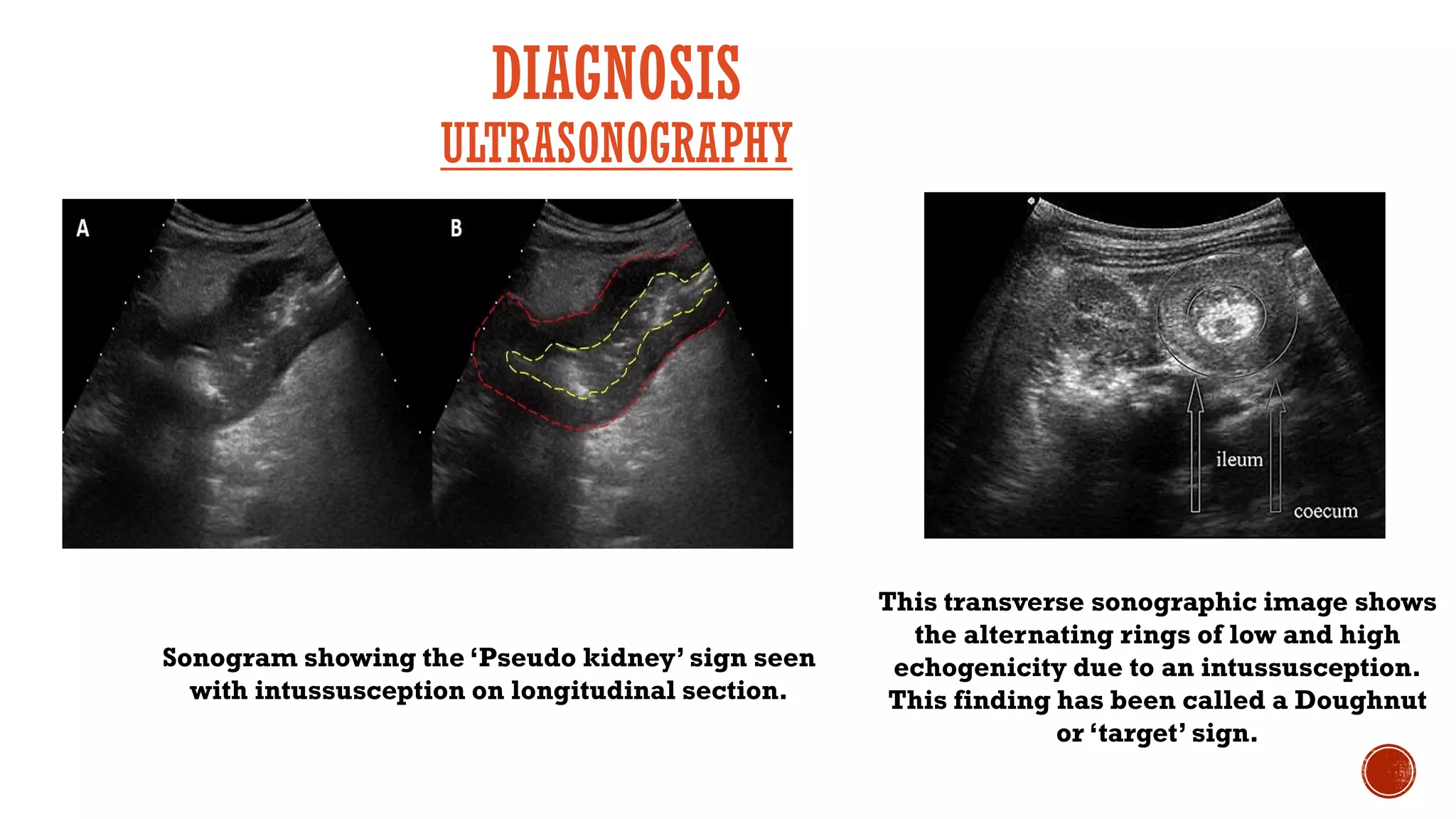 Intussusception