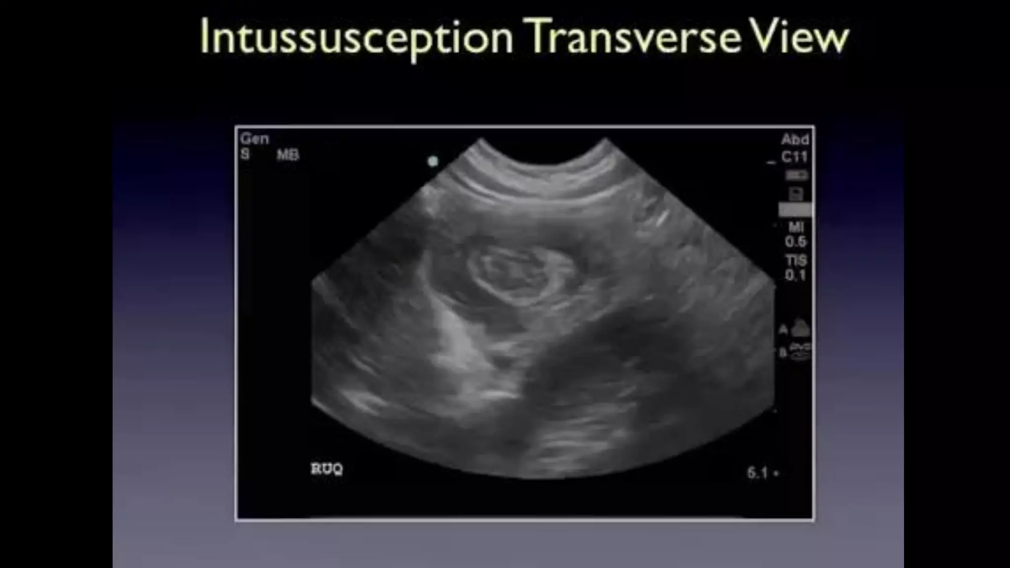 Intussusception