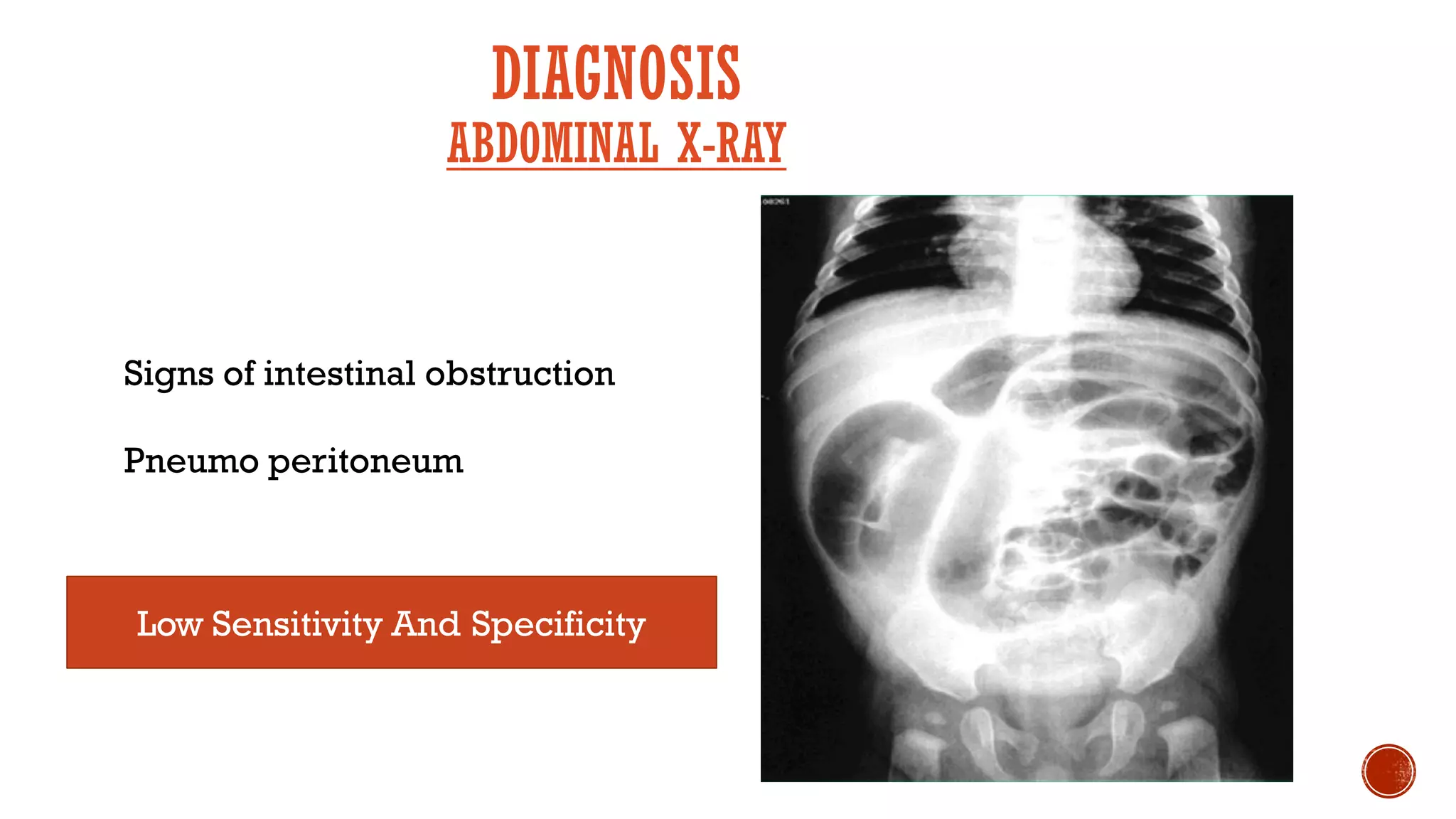 Intussusception
