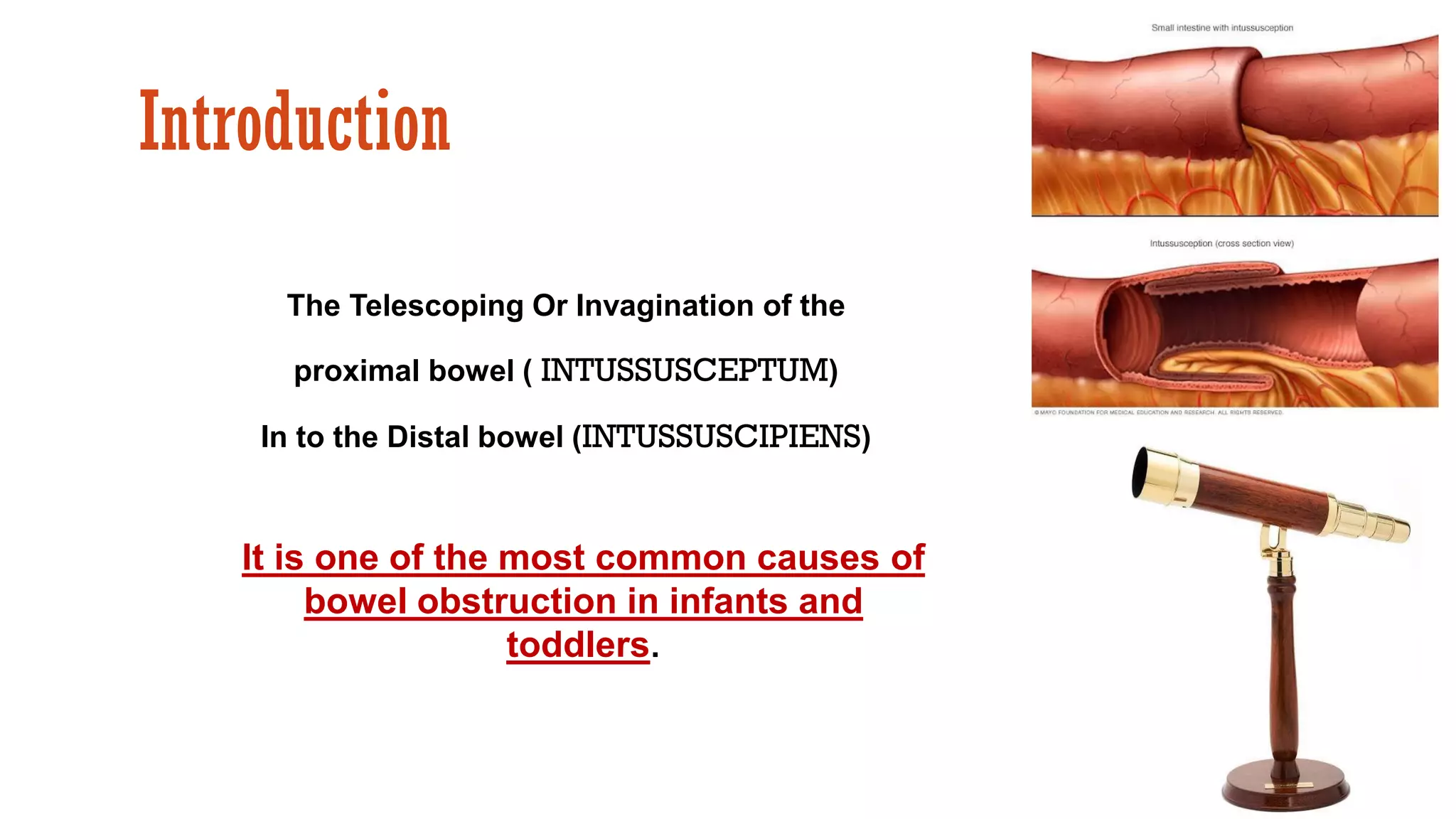 Intussusception