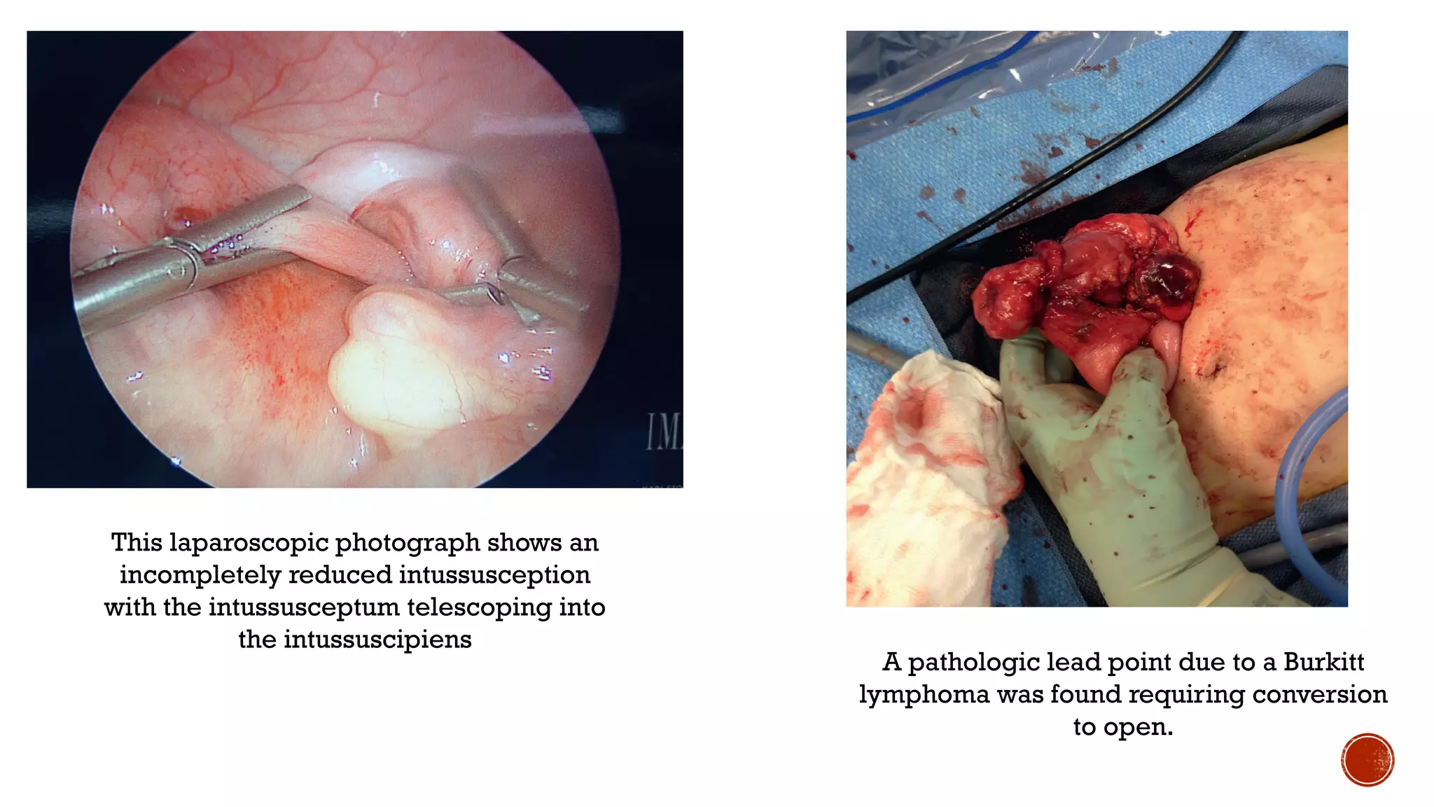 Intussusception