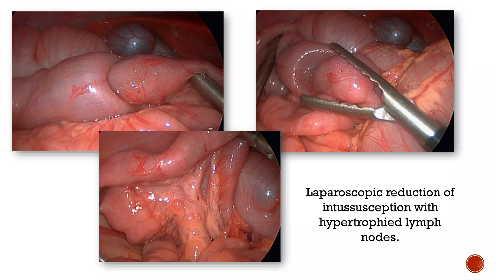 Intussusception