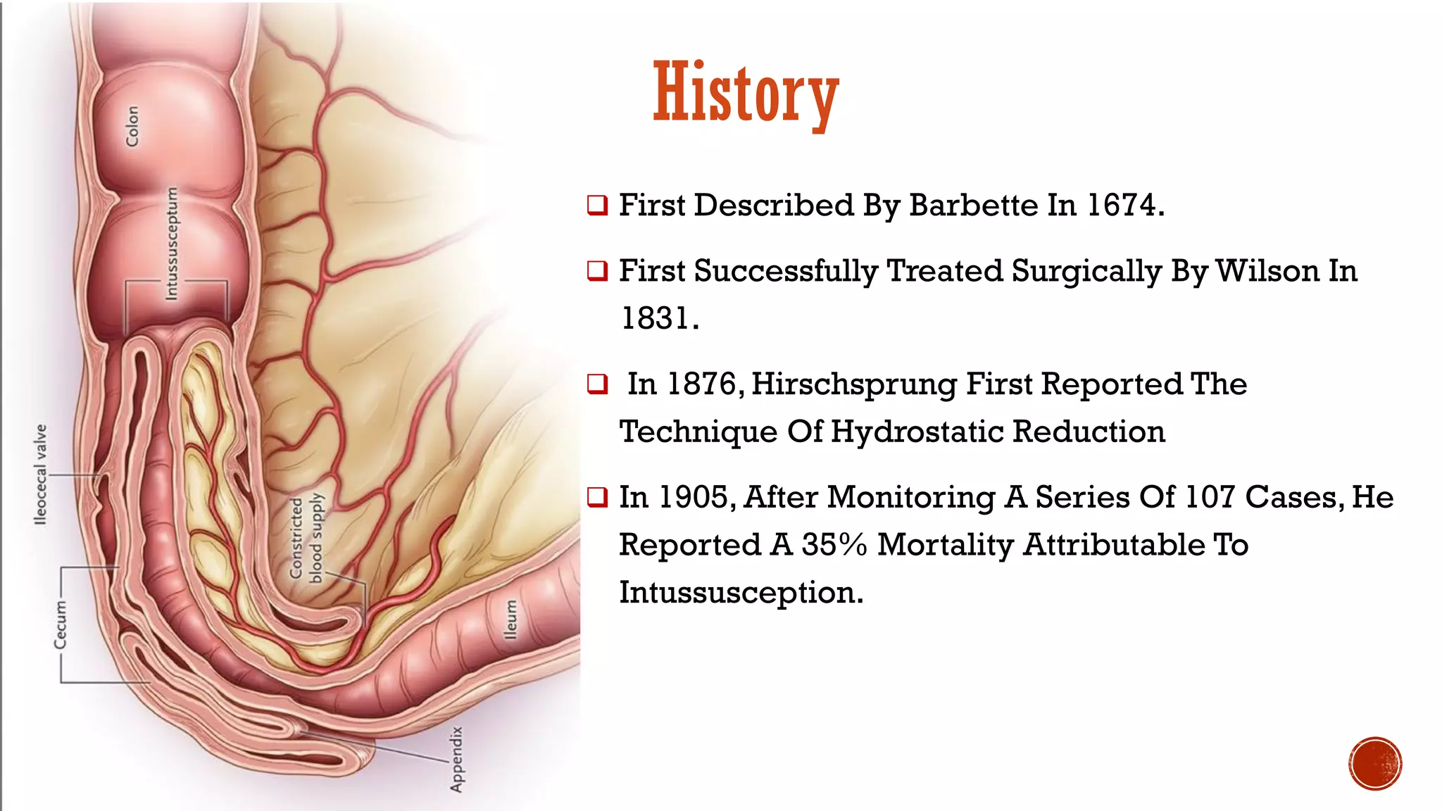 Intussusception