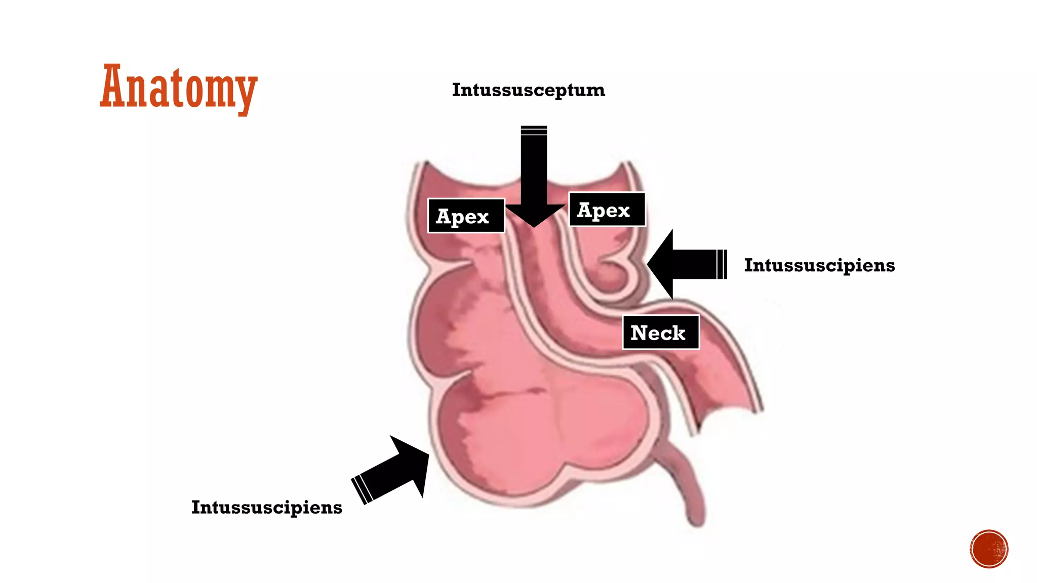 Intussusception