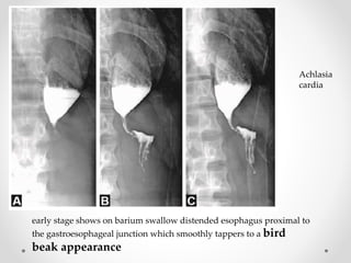Achlasia
cardia
early stage shows on barium swallow distended esophagus proximal to
the gastroesophageal junction which smoothly tappers to a bird
beak appearance
 