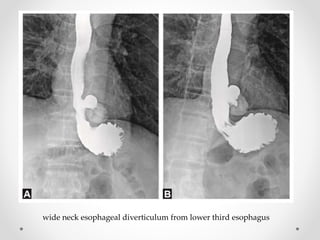 wide neck esophageal diverticulum from lower third esophagus
 