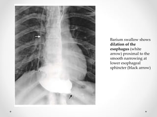 Barium swallow shows
dilation of the
esophagus (white
arrow) proximal to the
smooth narrowing at
lower esophageal
sphincter (black arrow)
 