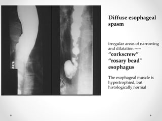 irregular areas of narrowing
and dilatation -----
“corkscrew”
“rosary bead"
esophagus
The esophageal muscle is
hypertrophied, but
histologically normal
Diffuse esophageal
spasm
 