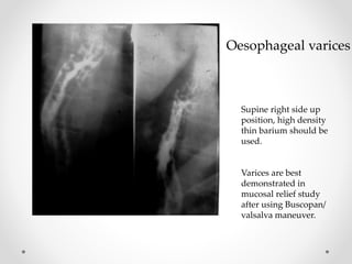 Oesophageal varices
Supine right side up
position, high density
thin barium should be
used.
Varices are best
demonstrated in
mucosal relief study
after using Buscopan/
valsalva maneuver.
 