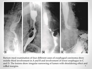 Barium meal examination of four different cases of esophageal carcinoma show
middle third involvement in A and B and involvement of lower esophagus in C
and D. The lesions show irregular narrowing of lumen with shouldering effect and
rolled margins.
 