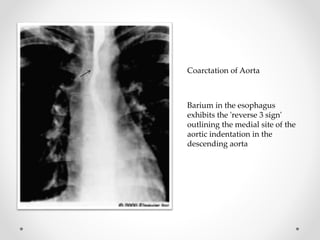 Barium in the esophagus
exhibits the 'reverse 3 sign'
outlining the medial site of the
aortic indentation in the
descending aorta
Coarctation of Aorta
 