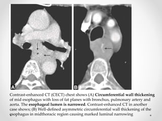 Contrast-enhanced CT (CECT) chest shows (A) Circumferential wall thickening
of mid esophagus with loss of fat planes with bronchus, pulmonary artery and
aorta. The esophageal lumen is narrowed. Contrast-enhanced CT in another
case shows; (B) Well-defined asymmetric circumferential wall thickening of the
esophagus in midthoracic region causing marked luminal narrowing
 