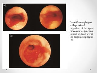 Barrett’s oesophagus
with proximal
migration of the squa-
mocolumnar junction
(a) and with a view of
the distal oesophagus
(b).
 