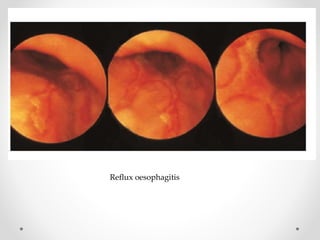 Reflux oesophagitis
 