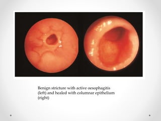 Benign stricture with active oesophagitis
(left) and healed with columnar epithelium
(right)
 