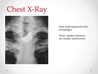 Chest X-Ray
False teeth impacted in the
oesophagus.
(Note: modern dentures
are usually radiolucent.)
 