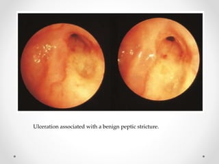 Ulceration associated with a benign peptic stricture.
 