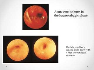 Acute caustic burn in
the haemorrhagic phase
The late result of a
caustic alkali burn with
a high oesophageal
stricture.
 