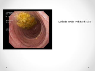 Achlasia cardia with food stasis
 