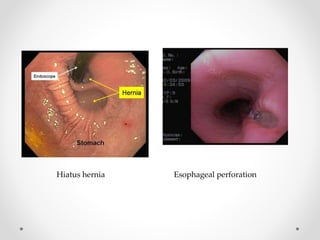 Hiatus hernia Esophageal perforation
 