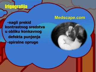 -nagli prekid
kontrastnog sredstva
u obliku konkavnog
defekta punjenja
-spiralne opruge
Irigografija
Medscape.com
 