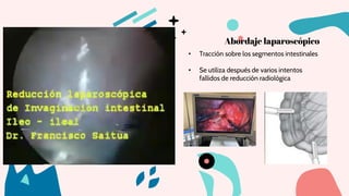 Abordaje laparoscópico
• Tracción sobre los segmentos intestinales
• Se utiliza después de varios intentos
fallidos de reducción radiológica
 