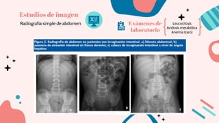 Estudios de imagen
Radiografia simple de abdomen Leucocitosis
Acidosis metabólica
Anemia (raro)
Exámenes de
laboratorio
 