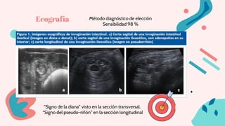 Método diagnóstico de elección
Sensibilidad 98 %
Ecografía
“Signo de la diana” visto en la sección transversal.
“Signo del pseudo-riñón” en la sección longitudinal
 