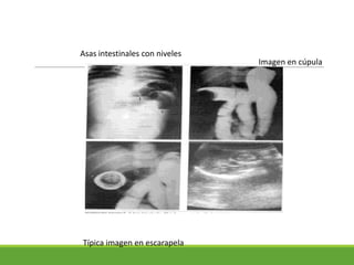 Asas intestinales con niveles
                                Imagen en cúpula




Típica imagen en escarapela
 