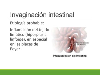 Invaginación intestinal
Etiología probable:
Inflamación del tejido
linfático (hiperplasia
linfoide), en especial
en las placas de
Peyer.
 