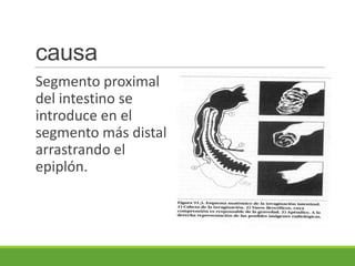 causa
Segmento proximal
del intestino se
introduce en el
segmento más distal
arrastrando el
epiplón.
 