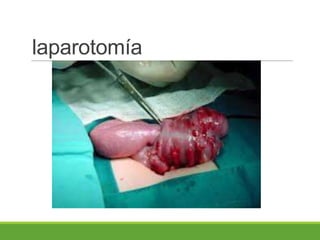 laparotomía
 