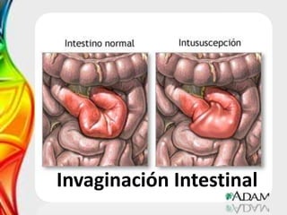 Invaginación Intestinal
 