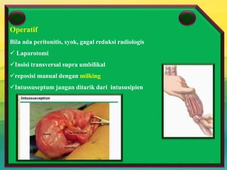 Perm Puri 2006
Terapi
 Non Operatif
Reduksi hidrostatik ( barium enema), Reduksi pnematik (udara)
Kontra indikasi peritonitis, sepsis, curiga usus nekrosis ( lebih 72 jam),ada
obstruksi mekanik total
Berhasil bila setelah rektal tube ditarik dari anus,barium keluar disertai
feses dan udara menyemprot dan pada fluoroskopi tampak refluk barium ke
ileum, masa menghilang
 Operatif
Bila ada peritonitis, syok, gagal reduksi radiologis
Operatif
Bila ada peritonitis, syok, gagal reduksi radiologis
 Laparotomi
Insisi transversal supra umbilikal
reposisi manual dengan milking
Intussuseptum jangan ditarik dari intususipien
12
 