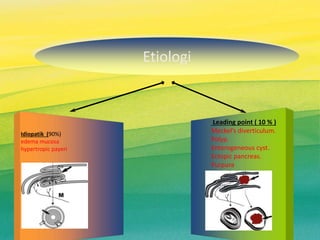Leading point ( 10 % )
Meckel’s diverticulum.
Polyp.
Enterogeneous cyst.
Ectopic pancreas.
Purpura
Idiopatik (90%)
edema mucosa
hypertropic payeri
Etiologi
 