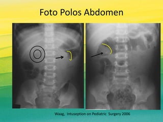 Foto Polos Abdomen
Waag, Intuseption on Pediatric Surgery 2006
 