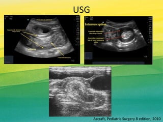 USG
Ascraft, Pediatric Surgery 8 edition, 2010
 