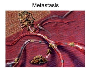 Metastasis
 