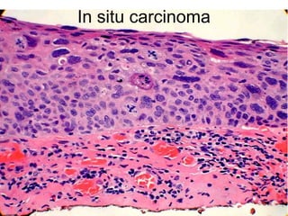 In situ carcinoma
 