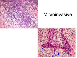 Microinvasive
 