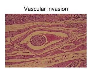 Vascular invasion
 