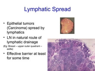 Lymphatic Spread
• Epithelial tumors
(Carcinoma) spread by
lymphatics
• LN in natural route of
lymphatic drainage
(Eg: Breast – upper outer quadrant –
axilla)
• Effective barrier at least
for some time
 